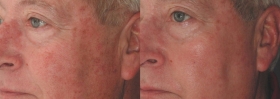 IPL for Facial Discoloration