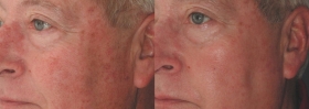 IPL for Facial Discoloration