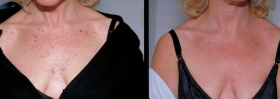IPL Treatment Photos