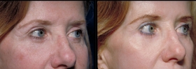 Pictures of laser skin resurfacing