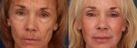 Facial fat grafting & skin resurfacing