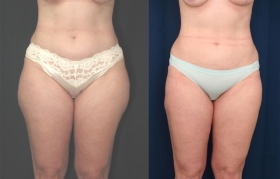 Back Liposuction Photos