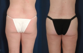 Liposuction before after results