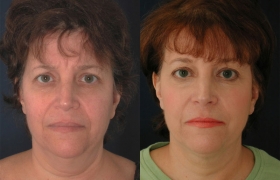 Facial liposuction