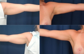 Upper Arm Liposuction
