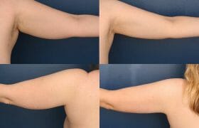 Upper Arm Liposuction