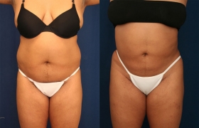 Before after liposuction
