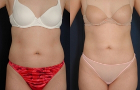 Best liposuction results