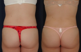 Waist liposuction
