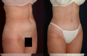 Abdominal liposuction