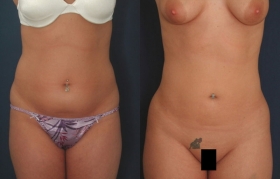 Liposuction pictures