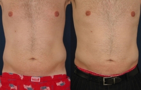 Male liposuction