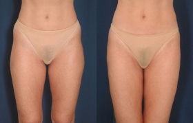 Hip & thigh liposuction