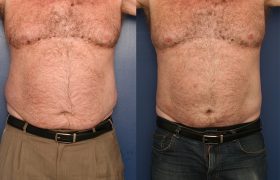lipo