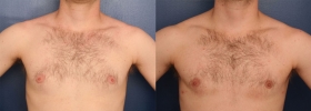 Male breast tissue excision
