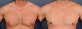 Before after male breast reduction