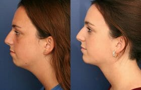 Cervicoplasty and Chin Implant