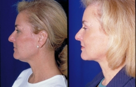 Necklift