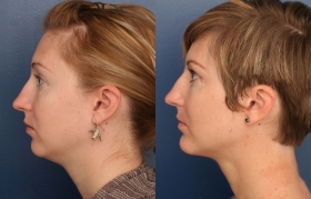 Cervicoplasty and Chin Implant