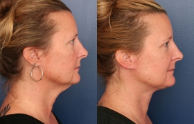 Before & After