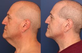 Z Plasty Cervicoplasty
