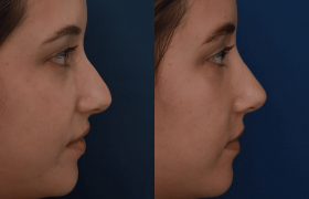 Rhinoplasty-case-1-view