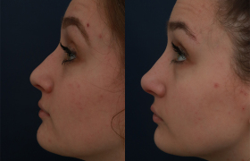 Rhinoplasty-case-2