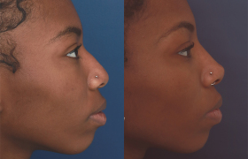 Rhinoplasty-case-3