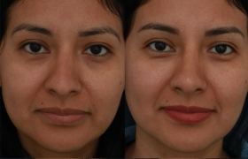 Rhinoplasty-case-4