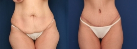 Post-bariatric plastic surgery pictures