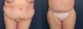 Plastic surgery after weight loss