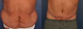 Before after post-bariatric plastic surgery