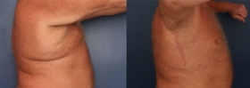 Post-bariatric surgery results