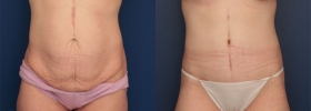 Circumferential abdominoplasty after weight loss