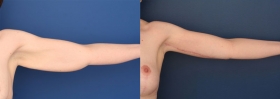 Arm Lift Surgery