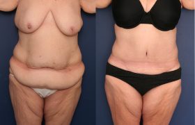 Circumferential Tummy Tuck after Bariatric Weight Loss Surgery