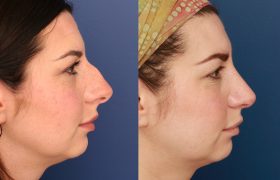 3_Rhinoplasty