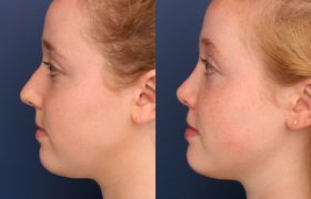 Septorhinoplasty-Crooked-Nose-Correction