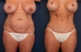 Circumferential Tummy Tuck