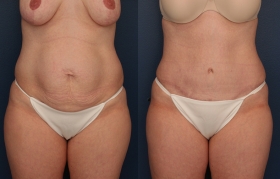 Tummy Tuck with Diastasis Repair