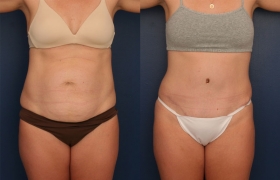 Full abdominoplasty
