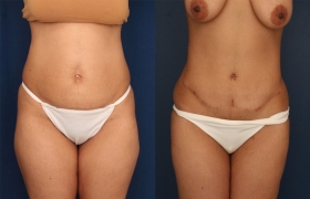 Tummy tuck and liposuction