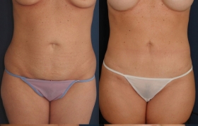 Tummy Tuck in Baltimore Before & After Photos
