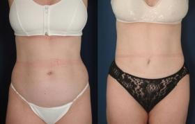 Abdominoplasty in Baltimore Before & After Photos