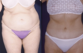 Tummy tuck pictures