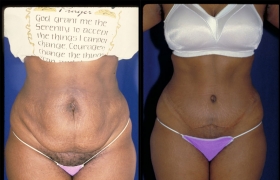 Standard abdominoplasty