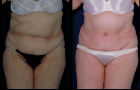 Tummy tuck photos