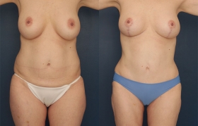 Tummy tuck with Breast lift