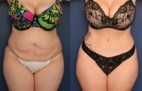 tummy-tuck