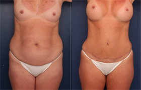 Tummy Tuck Mommy Makeover
